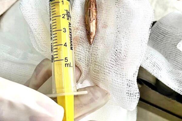 Хмельницькі лікарі провели надскладну операцію 27-річному військовому