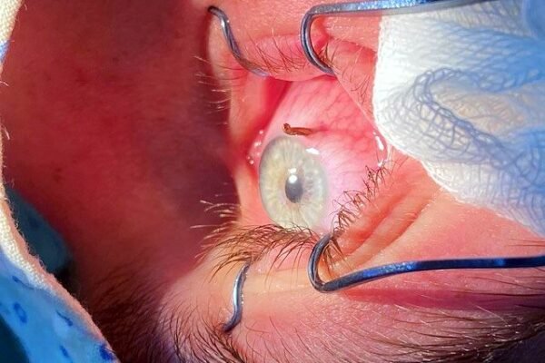 На Волині хірурги дістали шматок дроту з очного яблука дитини (ФОТО)