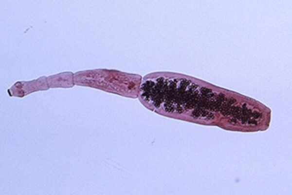 У печінці мешканця Львівщини виявили рідкісного паразита