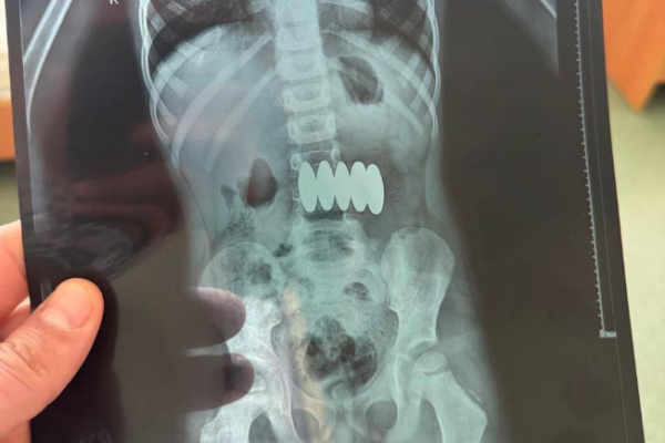 У Черкасах дитина проковтнула деталі від магнітного конструктора (ФОТО)